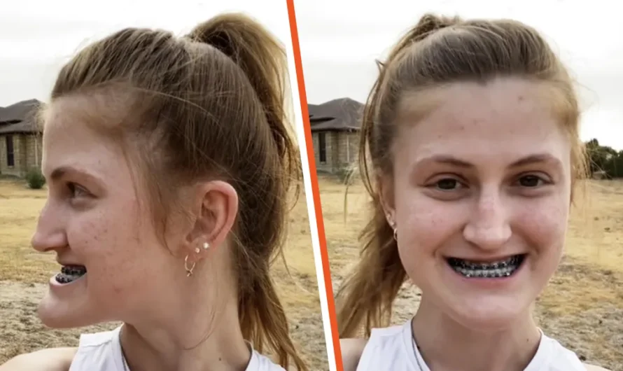 This Girl Underwent Double Jaw Surgery — Before-and-After Photos Left Everyone Speechless
